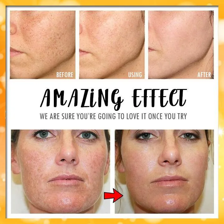 VC Whitening Dark Spots Remover